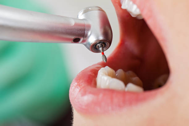 Best Knocked-Out Tooth (Avulsed Tooth) Treatment in Mount Sterling, OH